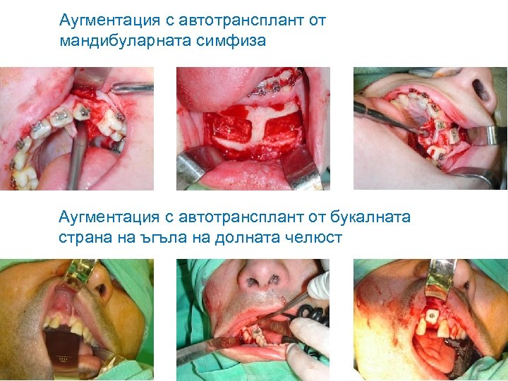 Аугментация с автотрансплант от мандибуларната симфиза Аугментация с автотрансплант от букалната страна на ъгъла