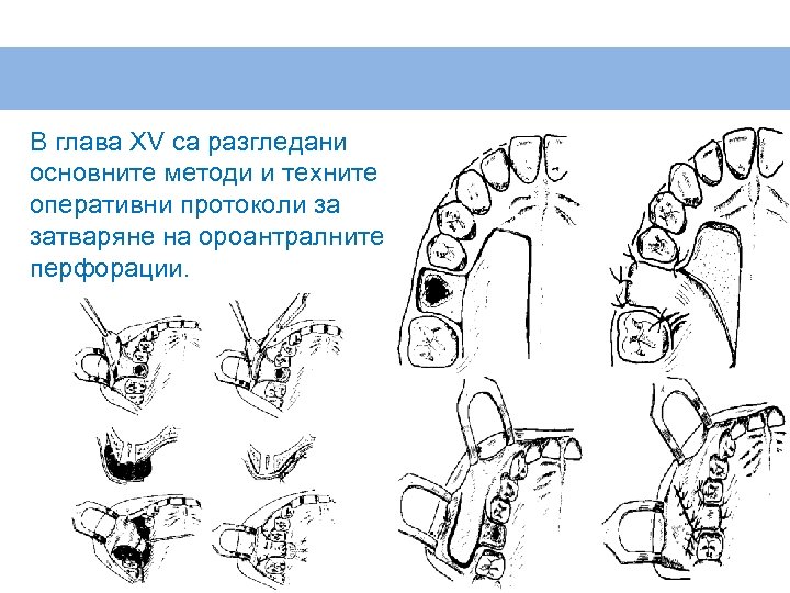 В глава XV са разгледани основните методи и техните оперативни протоколи за затваряне на