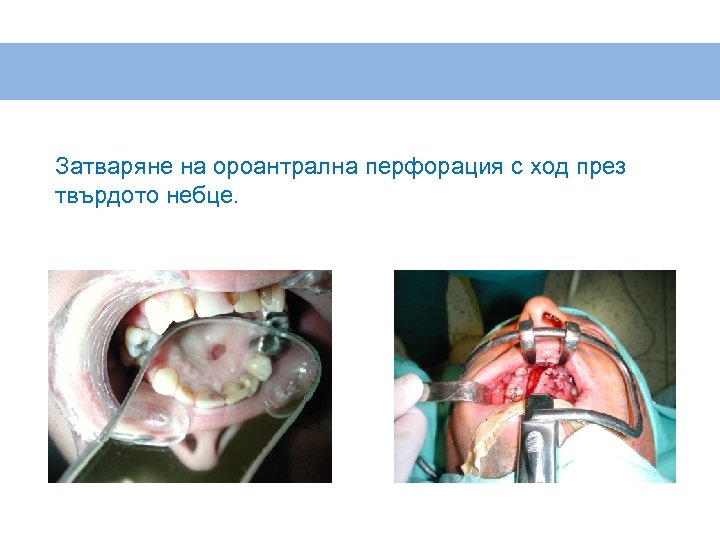 Затваряне на ороантрална перфорация с ход през твърдото небце. 