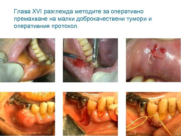 Глава XVI разглежда методите за оперативно премахване на малки доброкачествени тумори и оперативния протокол.