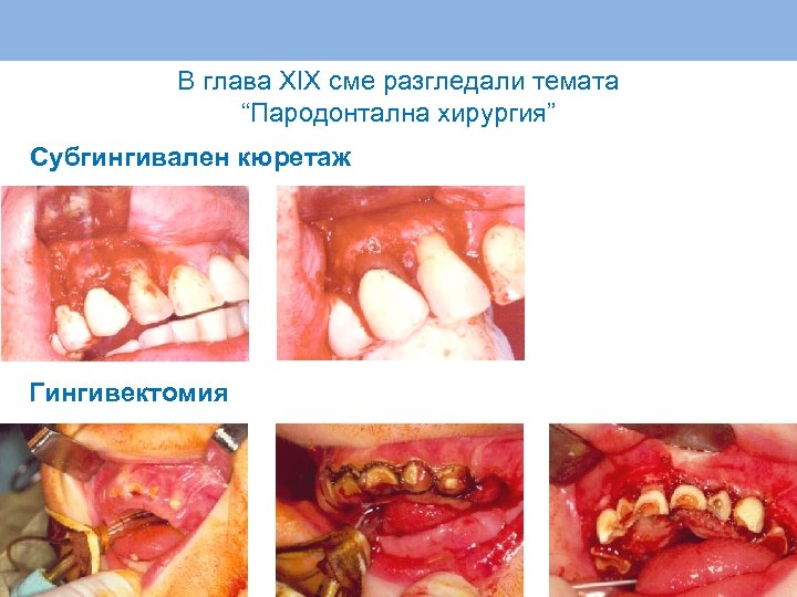 В глава XIX сме разгледали темата “Пародонтална хирургия” Субгингивален кюретаж Гингивектомия 