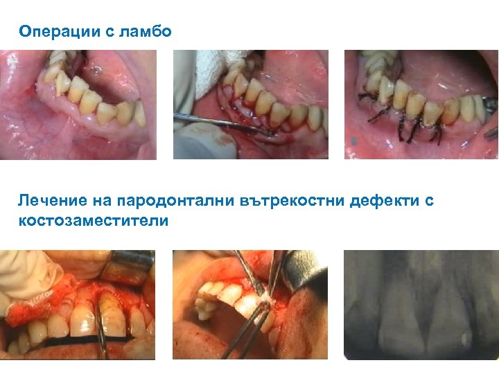 Операции с ламбо Лечение на пародонтални вътрекостни дефекти с костозаместители 