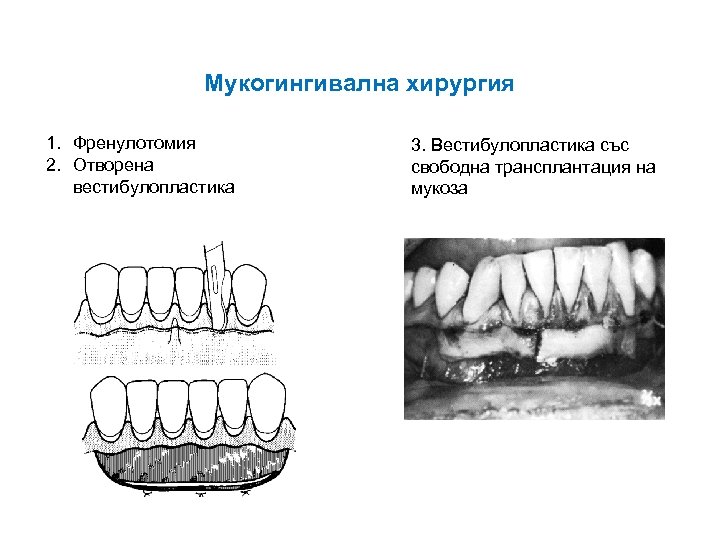 Мукогингивална хирургия 1. Френулотомия 2. Отворена вестибулопластика 3. Вестибулопластика със свободна трансплантация на мукоза