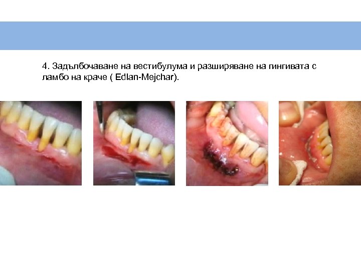 4. Задълбочаване на вестибулума и разширяване на гингивата с ламбо на краче ( Edlan-Mejchar).