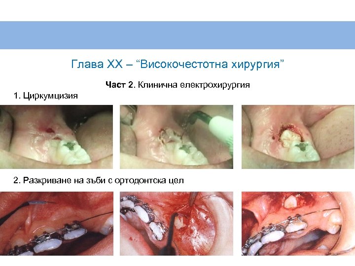 Глава XX – “Високочестотна хирургия” Част 2. Клинична електрохирургия 1. Циркумцизия 2. Разкриване на