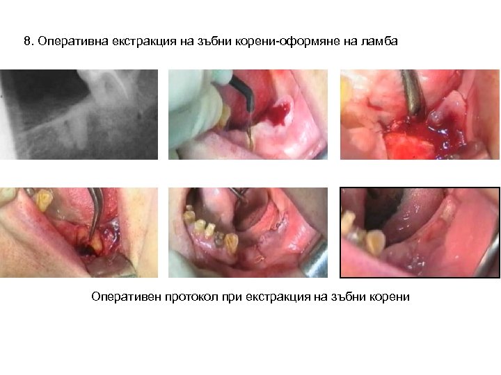8. Оперативна екстракция на зъбни корени-оформяне на ламба Оперативен протокол при екстракция на зъбни