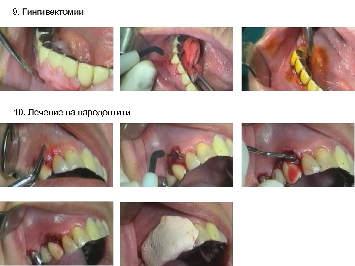 9. Гингивектомии 10. Лечение на пародонтити 