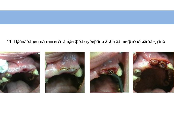 11. Препарация на гингивата при фрактурирани зъби за щифтово изграждане 