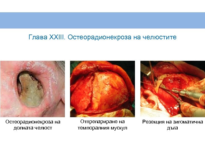 Глава XXIII. Остеорадионекроза на челюстите Остеорадионекроза на долната челюст Отпрепариране на темпоралния мускул Резекция