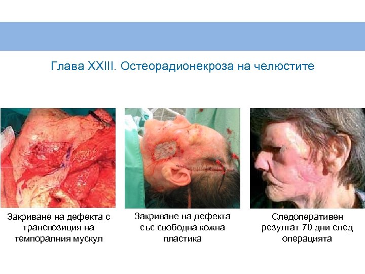 Глава XXIII. Остеорадионекроза на челюстите Закриване на дефекта с транспозиция на темпоралния мускул Закриване