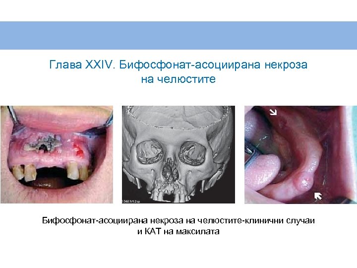 Глава XXIV. Бифосфонат-асоциирана некроза на челюстите-клинични случаи и КАТ на максилата 