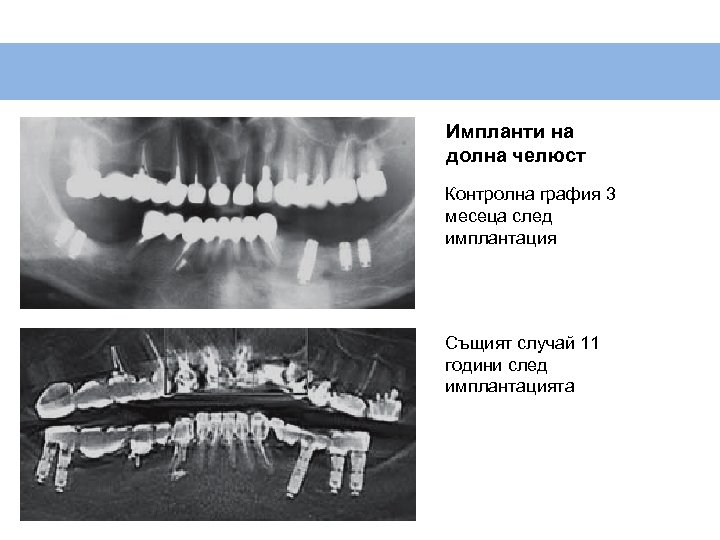 Импланти на долна челюст Контролна графия 3 месеца след имплантация Същият случай 11 години