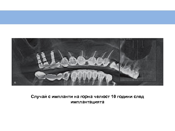 Случай с импланти на горна челюст 10 години след имплантацията 