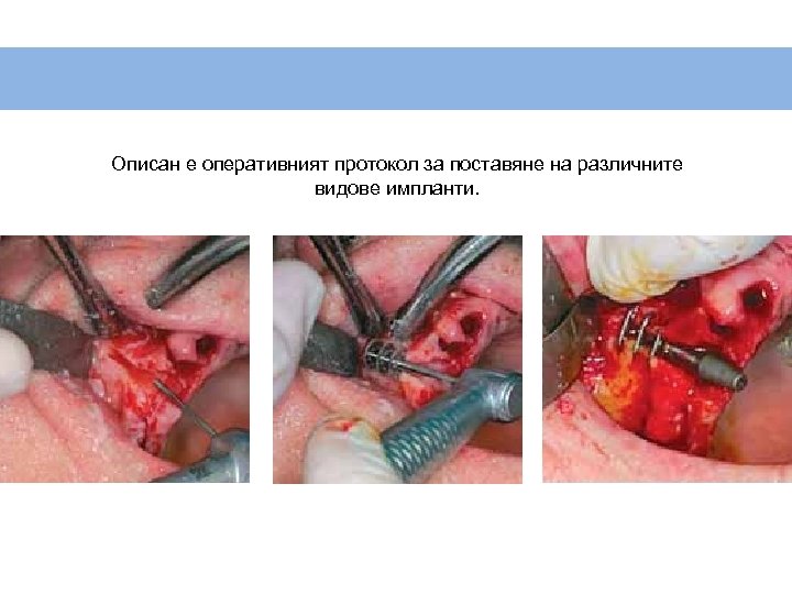 Описан е оперативният протокол за поставяне на различните видове импланти. 