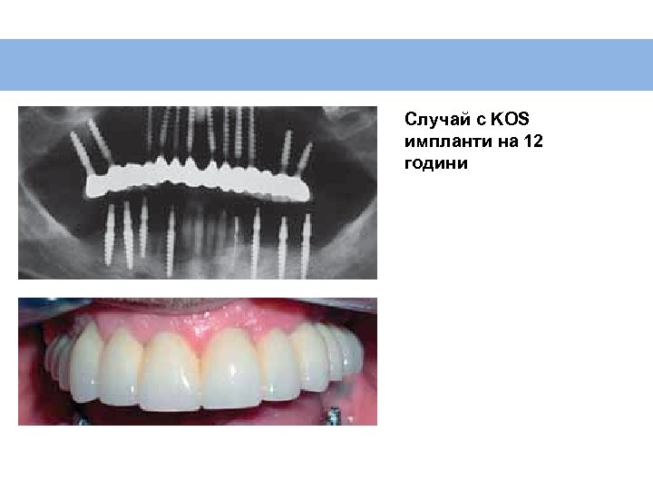 Случай с KOS импланти на 12 години 