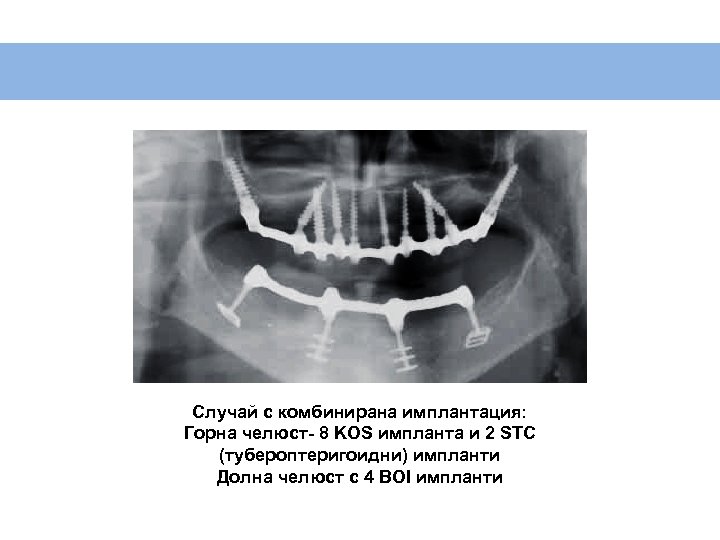 Случай с комбинирана имплантация: Горна челюст- 8 KOS импланта и 2 STC (тубероптеригоидни) импланти