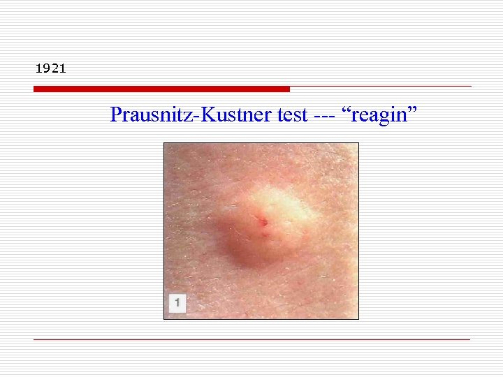1921 Prausnitz-Kustner test --- “reagin” 