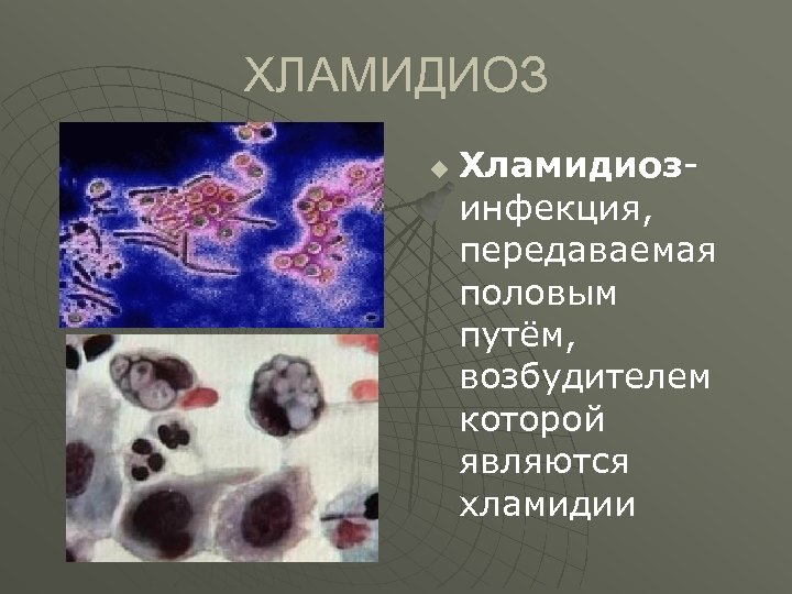 ХЛАМИДИОЗ u Хламидиозинфекция, передаваемая половым путём, возбудителем которой являются хламидии 