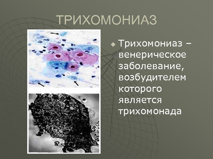 ТРИХОМОНИАЗ u Трихомониаз – венерическое заболевание, возбудителем которого является трихомонада 