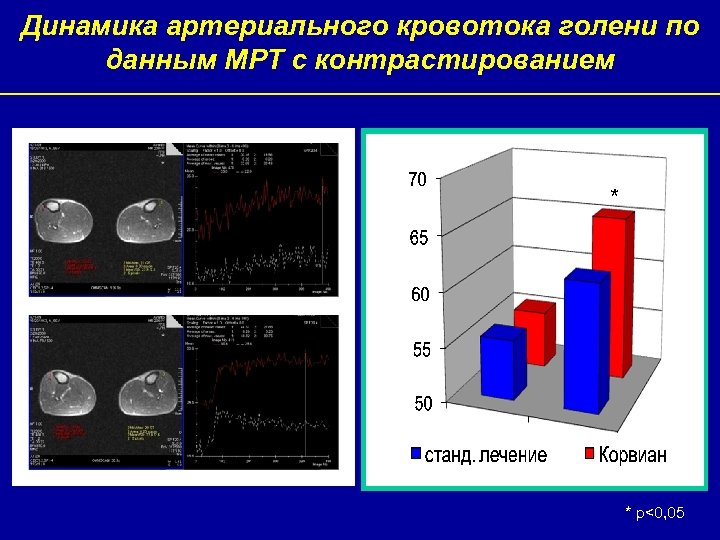Динамика артериального кровотока голени по данным МРТ с контрастированием * * р<0, 05 