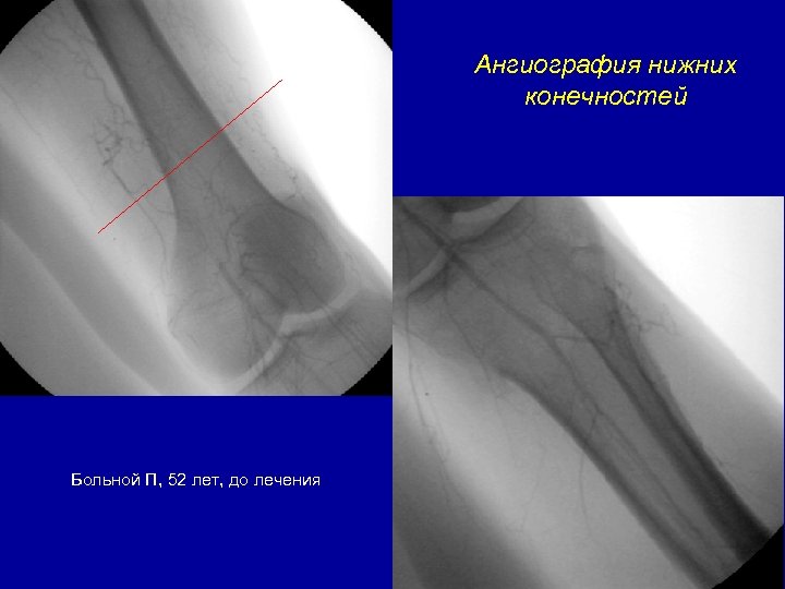 Ангиография нижних конечностей Больной П, 52 лет, до лечения 
