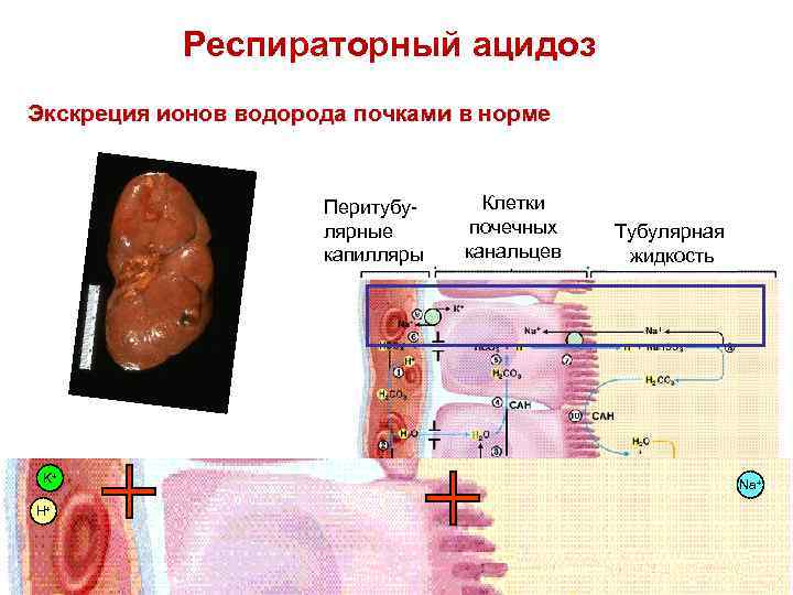 Респираторный ацидоз Экскреция ионов водорода почками в норме Перитубулярные капилляры K+ Тубулярная жидкость Na+