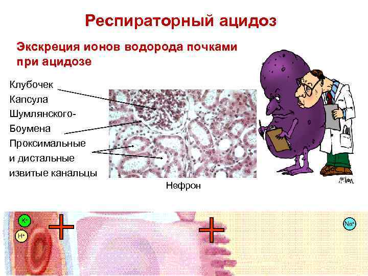 Респираторный ацидоз Экскреция ионов водорода почками при ацидозе Клубочек Капсула Шумлянского. Боумена Проксимальные и