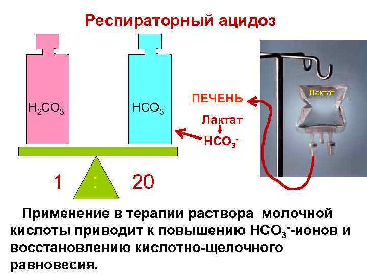 Респираторный ацидоз H 2 CO 3 HCO 3 - ПЕЧЕНЬ Лактат HCO 3 -