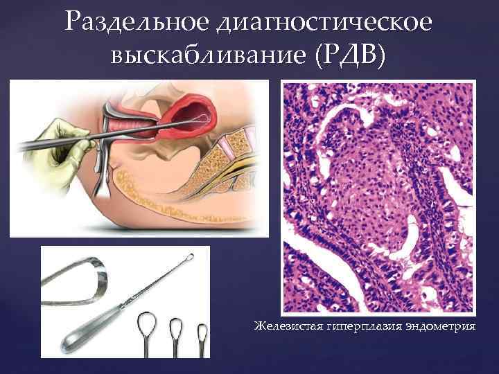 Раздельное диагностическое выскабливание (РДВ) Железистая гиперплазия эндометрия 