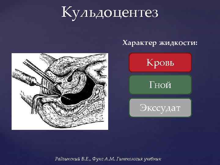 Кульдоцентез Характер жидкости: Кровь Гной Экссудат Радзинский В. Е. , Фукс А. М. Гинекология