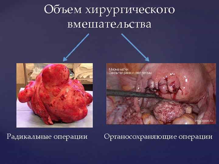 Объем хирургического вмешательства Радикальные операции Органосохраняющие операции 