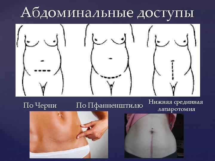 Абдоминальные доступы По Черни По Пфанненштилю Нижняя срединная лапаротомия 