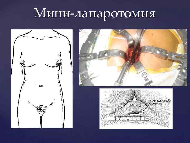Мини-лапаротомия 
