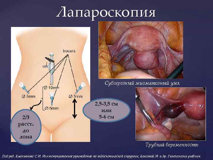 Лапароскопия Субсерозный миоматозный узел 2/3 расст. до лона 2, 5 -3, 5 см или