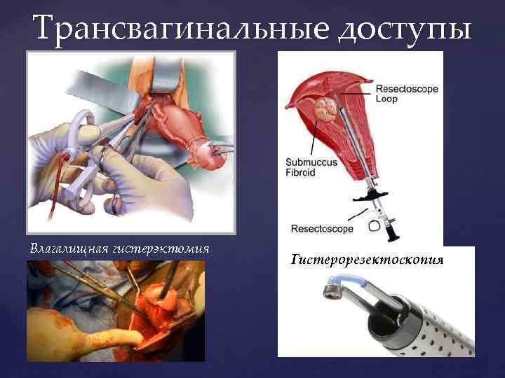 Трансвагинальные доступы Влагалищная гистерэктомия Гистерорезектоскопия 