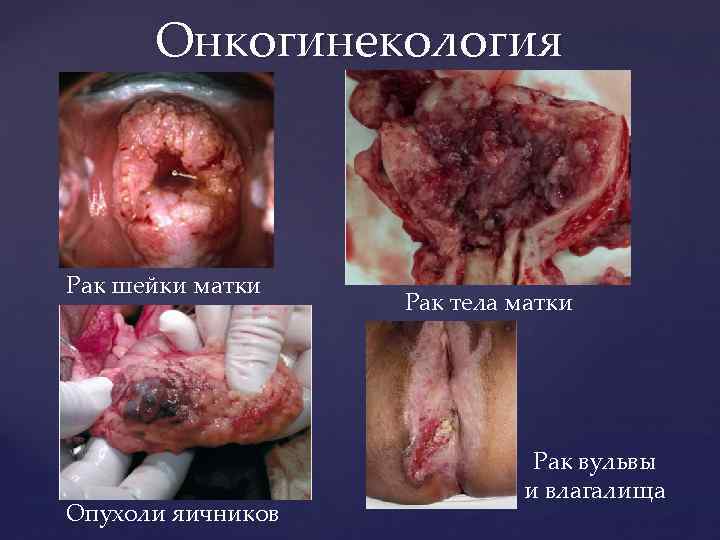 Онкогинекология Рак шейки матки Опухоли яичников Рак тела матки Рак вульвы и влагалища 