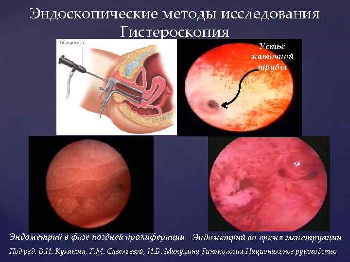 Эндоскопические методы исследования Гистероскопия Устье маточной трубы Эндометрий в фазе поздней пролиферации Эндометрий во