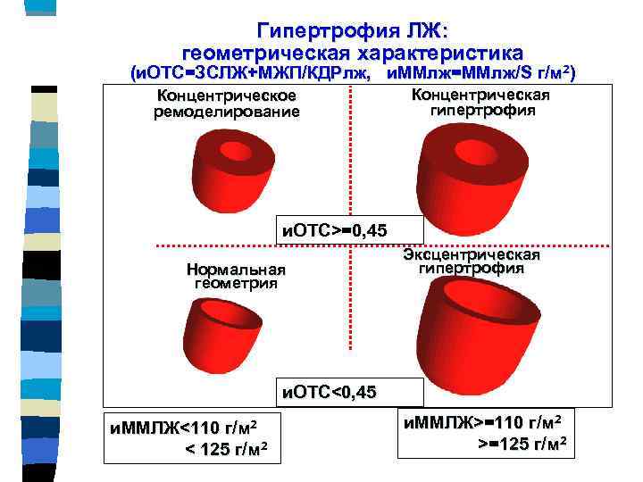 Гипертрофия ЛЖ: геометрическая характеристика (и. ОТС=ЗСЛЖ+МЖП/КДРлж, и. ММлж=ММлж/S г/м 2) Концентрическое ремоделирование Концентрическая гипертрофия