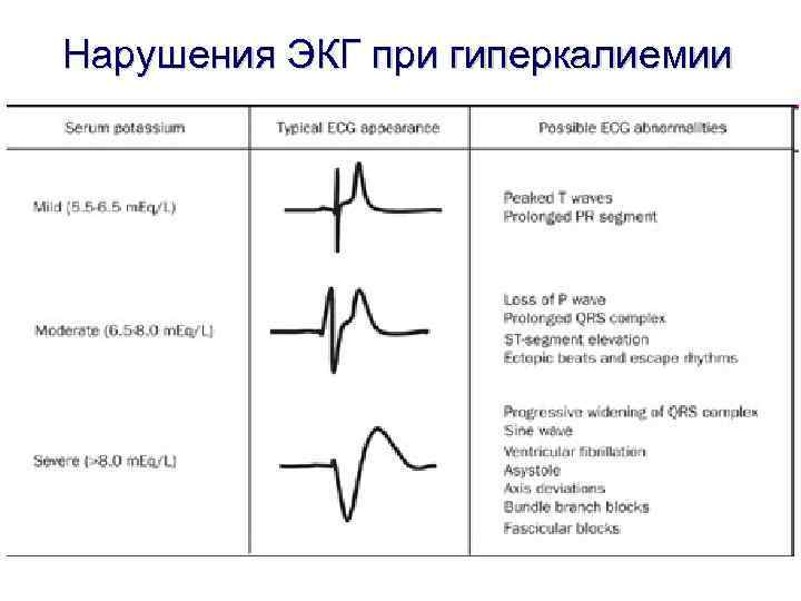 Нарушения ЭКГ при гиперкалиемии 