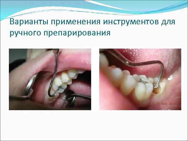 Варианты применения инструментов для ручного препарирования 