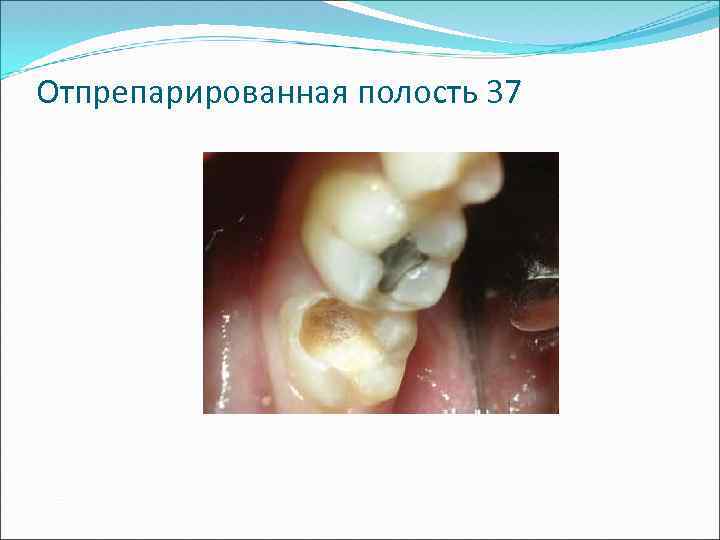 Отпрепарированная полость 37 