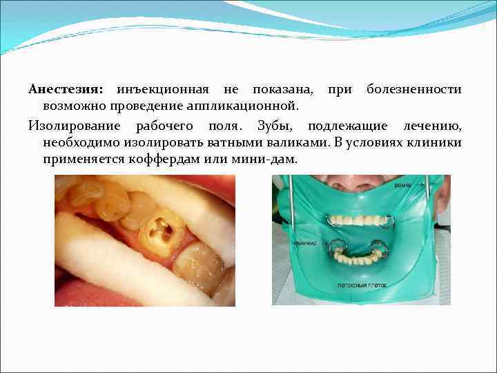 Анестезия: инъекционная не показана, при болезненности возможно проведение аппликационной. Изолирование рабочего поля. Зубы, подлежащие