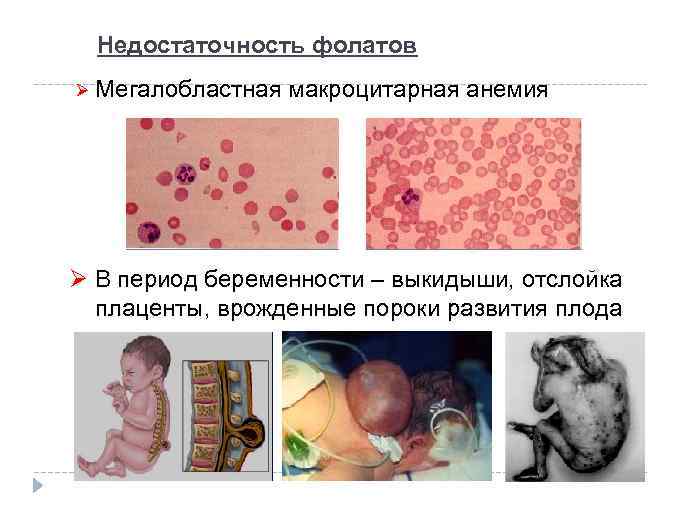 Недостаточность фолатов Ø Мегалобластная макроцитарная анемия Ø В период беременности – выкидыши, отслойка плаценты,