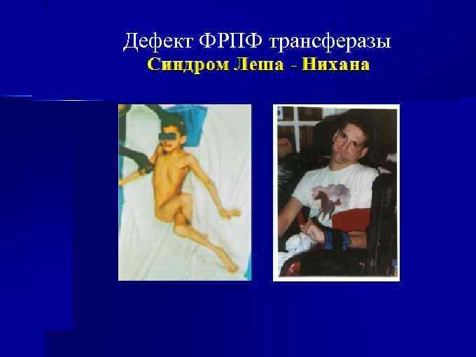 Дефект ФРПФ трансферазы 