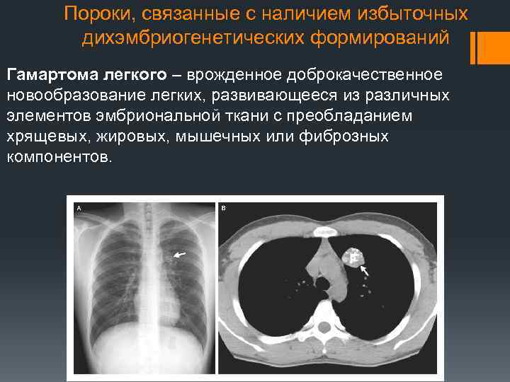 Пороки, связанные с наличием избыточных дихэмбриогенетических формирований Гамартома легкого – врожденное доброкачественное новообразование легких,