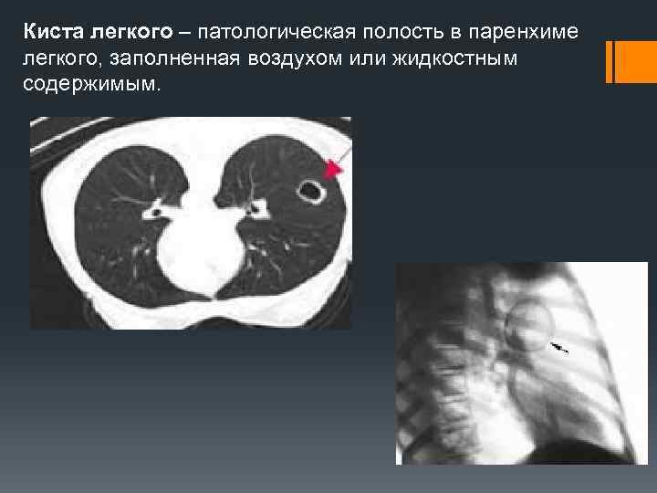 Киста легкого – патологическая полость в паренхиме легкого, заполненная воздухом или жидкостным содержимым. 