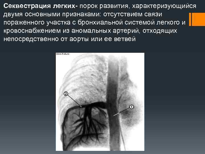 Секвестрация легких- порок развития, характеризующийся двумя основными признаками: отсутствием связи пораженного участка с бронхиальной