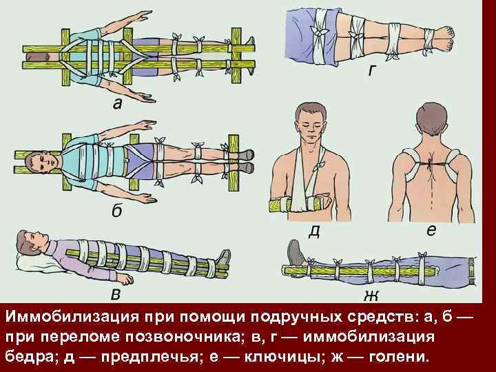 Матрас при переломе позвоночника