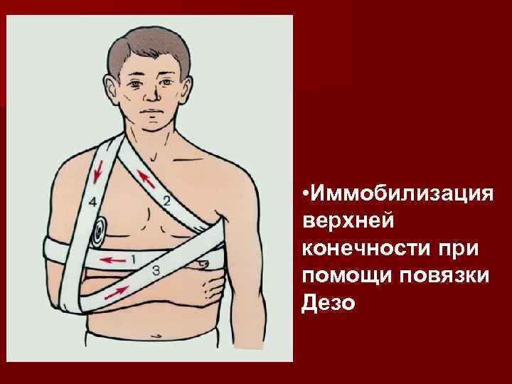 Повязка дезо схема