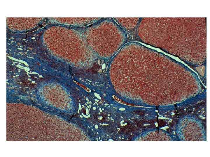Стволовые клетки печени. Монолобулярный цирроз. Мультилобулярный цирроз это. Цирроз под микроскопом.